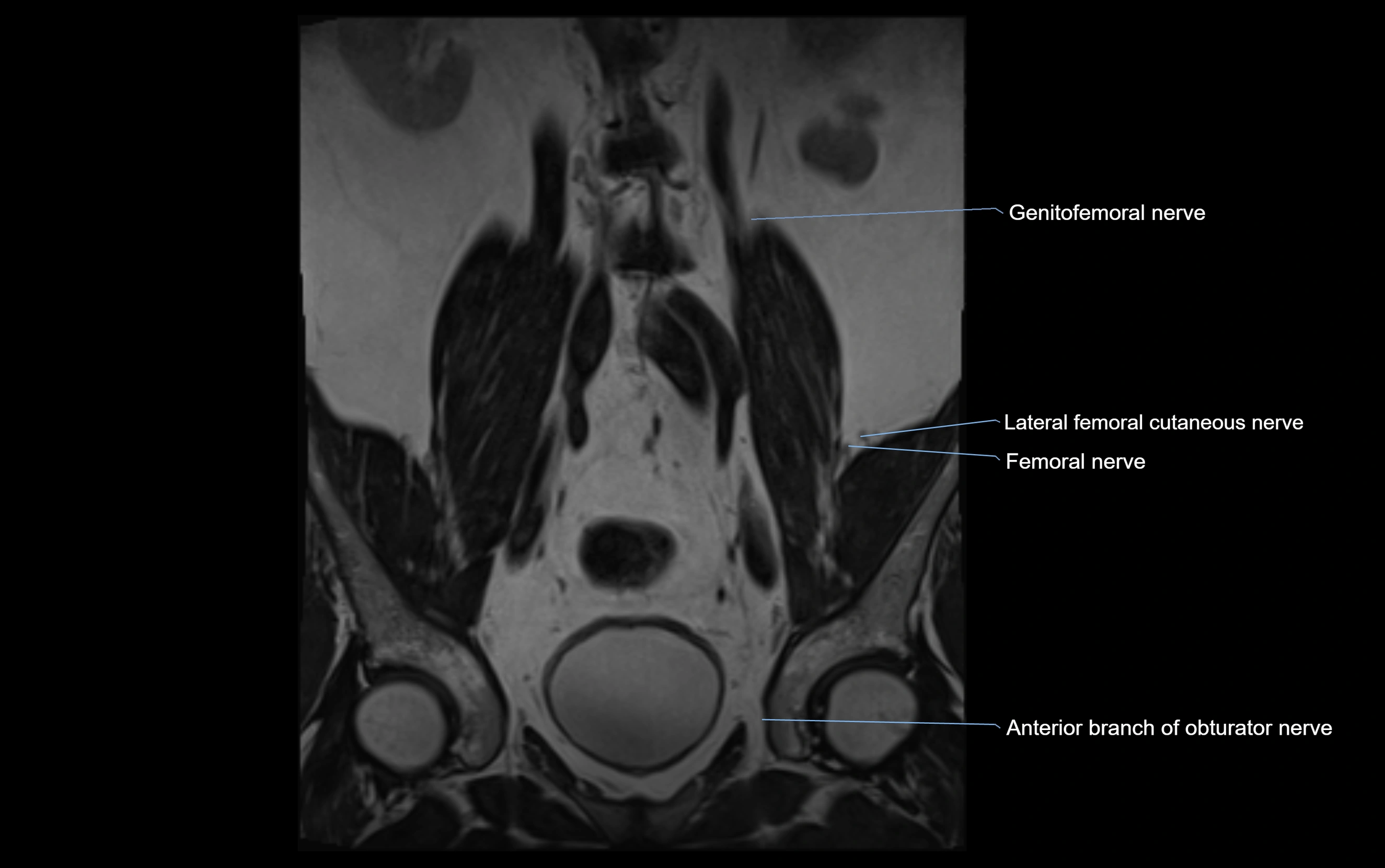 MR lumbosacral plexus cross sectional anatomy 3T  radiology  image-img-09001-00011.webp